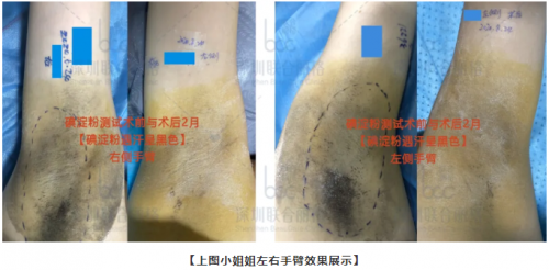 「真人测评」miradry清新微波止汗祛腋臭60天，运动后腋下超干爽！ 健康 第4张