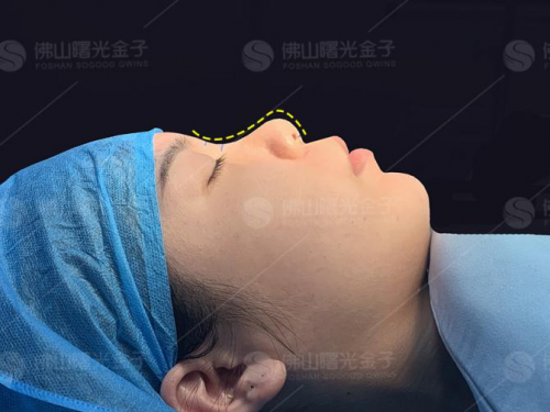 曙光金子隆鼻巨匠刘云忠：如果一辈子只坚持做好一件事，那就是鼻整形！ 美容健康 第7张