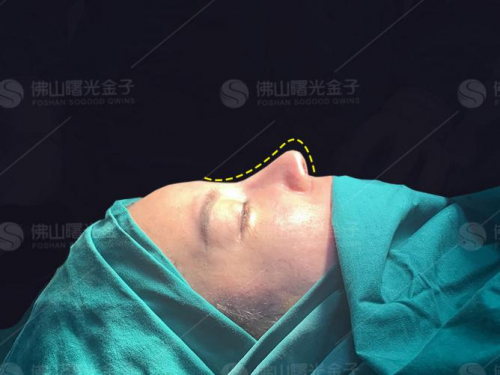 曙光金子隆鼻巨匠刘云忠：如果一辈子只坚持做好一件事，那就是鼻整形！ 美容健康 第8张