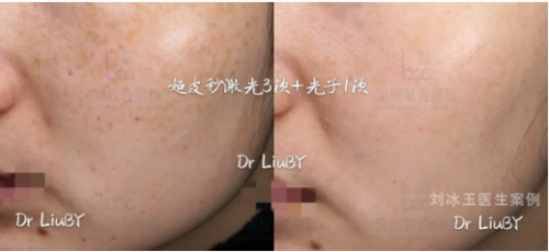 皮肤科医生推荐的祛斑套组「超皮秒＋超光子」到底有多牛？ 美容健康 第2张