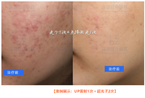 祛痘痘、痘印，平痘坑：UP雷射＋超光子，痘肌油皮的福音！ 美容健康 第3张