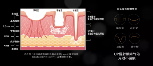 祛痘痘、痘印，平痘坑：UP雷射＋超光子，痘肌油皮的福音！ 美容健康 第4张