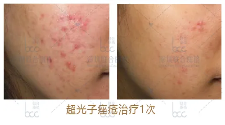 祛痘痘、痘印，平痘坑：UP雷射＋超光子，痘肌油皮的福音！ 美容健康 第7张