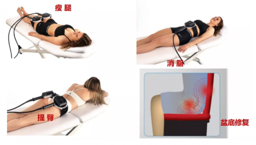 有了fotona星丽人“全能增肌王”，马甲线、蜜桃臀、小鸟腿都不是事！ 健康 第1张