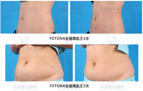 有了fotona星丽人“全能增肌王”，马甲线、蜜桃臀、小鸟腿都不是事！ 健康 第4张