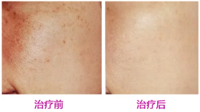 同属抗衰激光，fotona4d与5gmax怎么选？ 美容健康 第2张