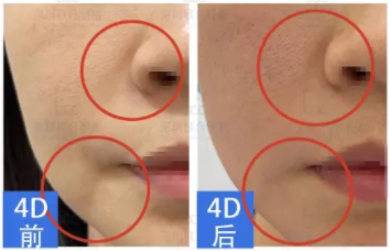 同属抗衰激光，fotona4d与5gmax怎么选？ 美容健康 第3张