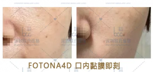 同属抗衰激光，fotona4d与5gmax怎么选？ 美容健康 第5张
